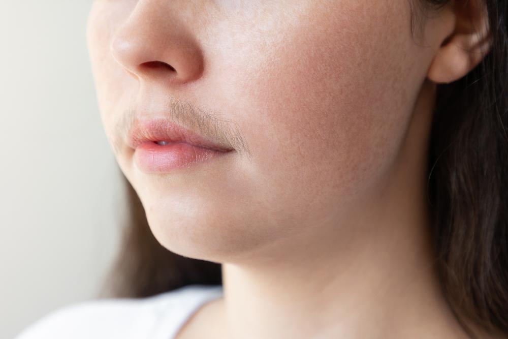 Does Spearmint Oil Really Work For Hirsutism?
