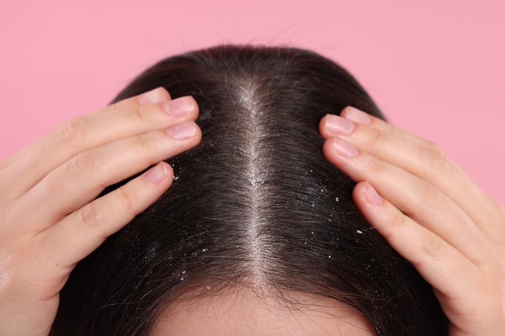 Tea Tree Oil For Dandruff: How It Works And Usage